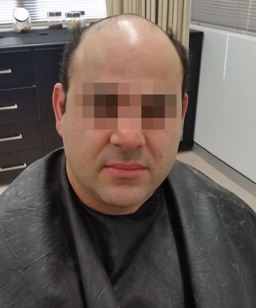 sydney hair loss clinic